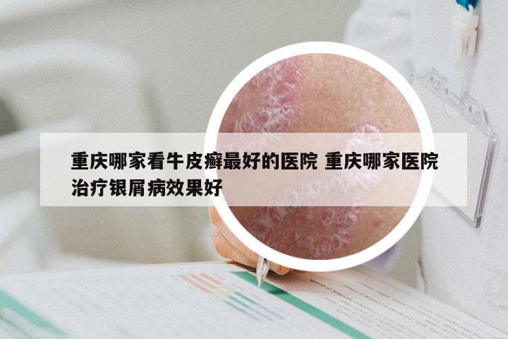 重庆哪家看牛皮癣最好的医院 重庆哪家医院治疗银屑病效果好