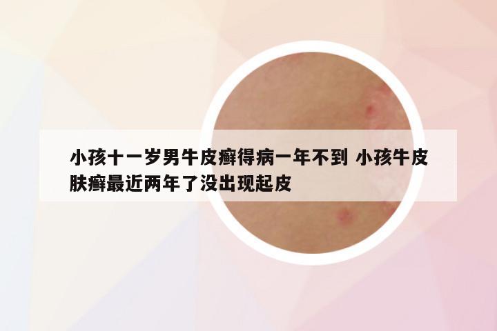 小孩十一岁男牛皮癣得病一年不到 小孩牛皮肤癣最近两年了没出现起皮