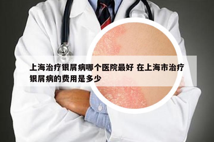 上海治疗银屑病哪个医院最好 在上海市治疗银屑病的费用是多少