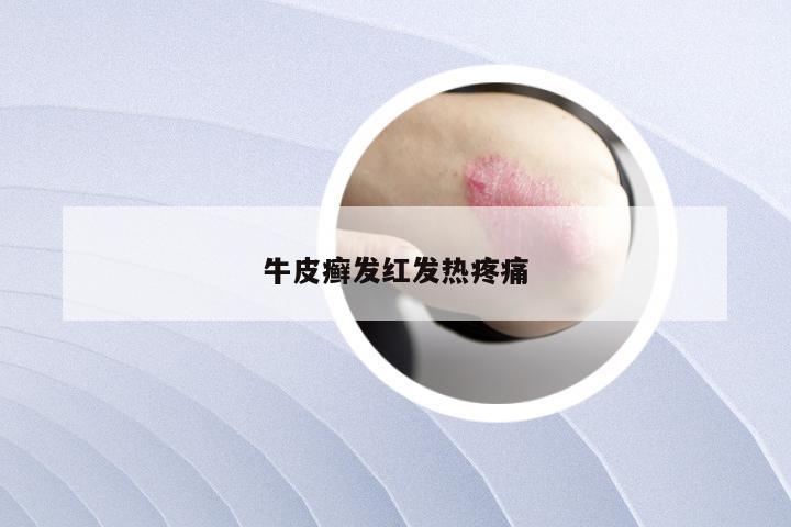 牛皮癣发红发热疼痛