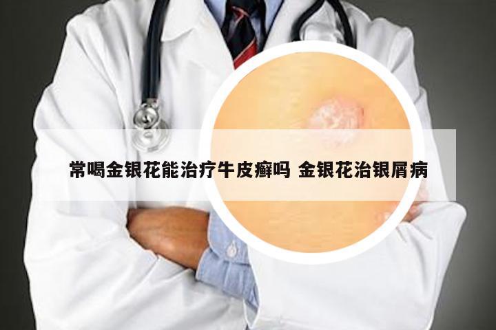 常喝金银花能治疗牛皮癣吗 金银花治银屑病
