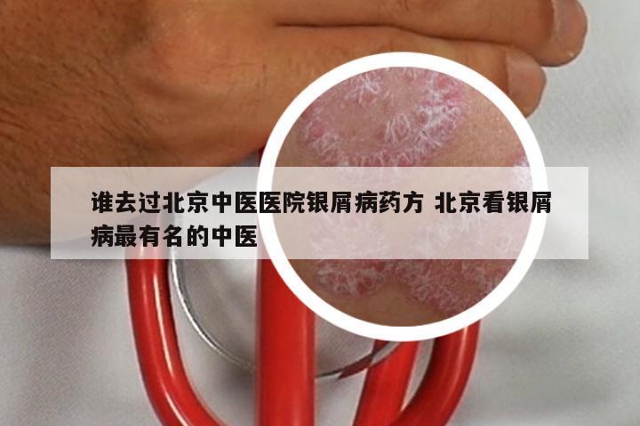 谁去过北京中医医院银屑病药方 北京看银屑病最有名的中医