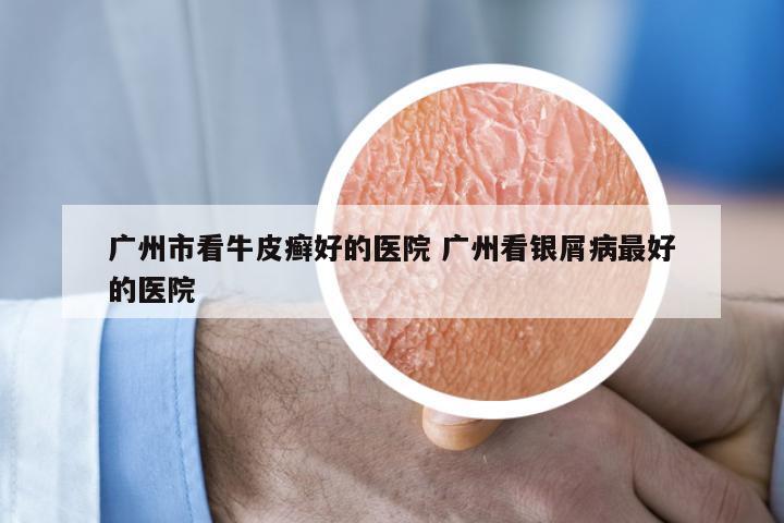 广州市看牛皮癣好的医院 广州看银屑病最好的医院