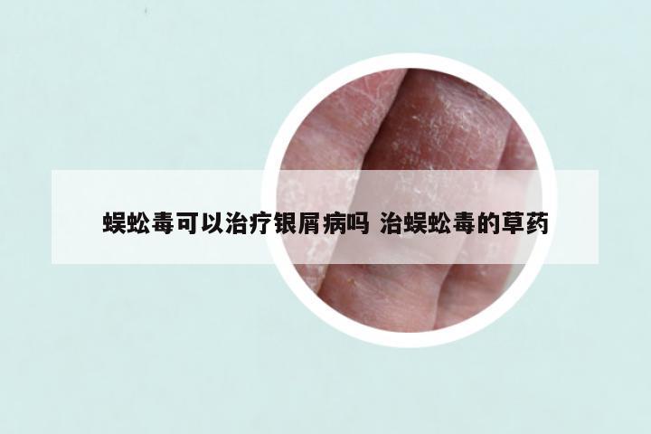 蜈蚣毒可以治疗银屑病吗 治蜈蚣毒的草药