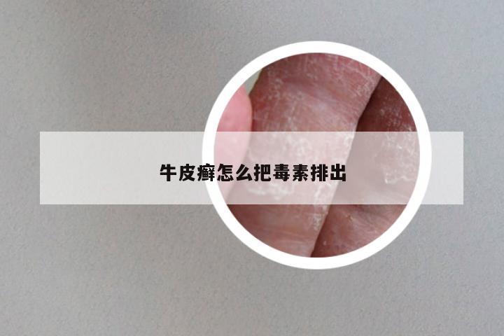 牛皮癣怎么把毒素排出