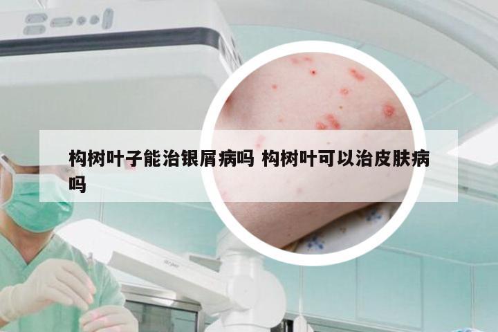 构树叶子能治银屑病吗 构树叶可以治皮肤病吗