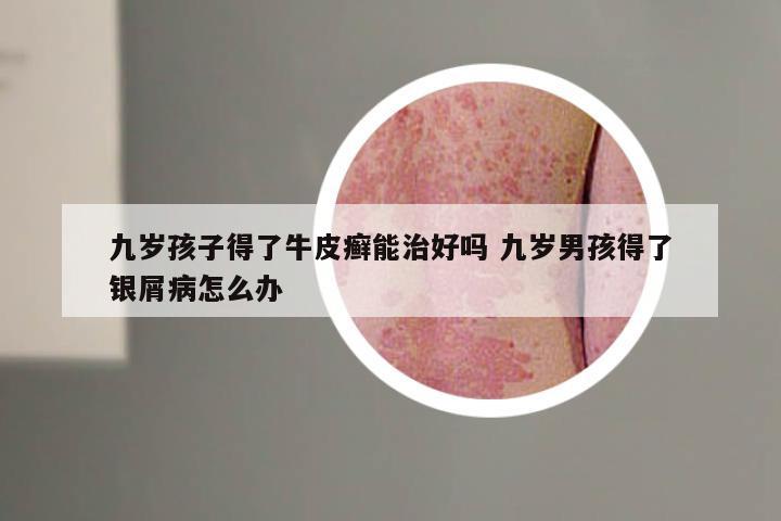 九岁孩子得了牛皮癣能治好吗 九岁男孩得了银屑病怎么办