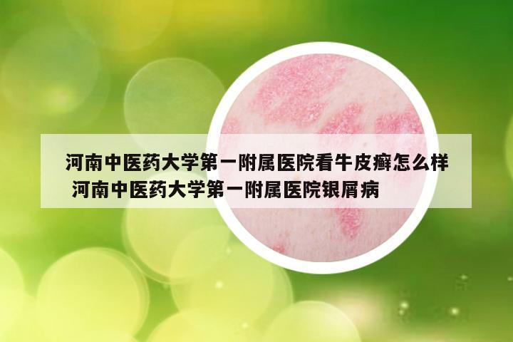 河南中医药大学第一附属医院看牛皮癣怎么样 河南中医药大学第一附属医院银屑病