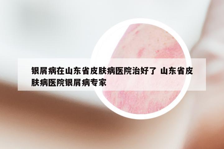 银屑病在山东省皮肤病医院治好了 山东省皮肤病医院银屑病专家