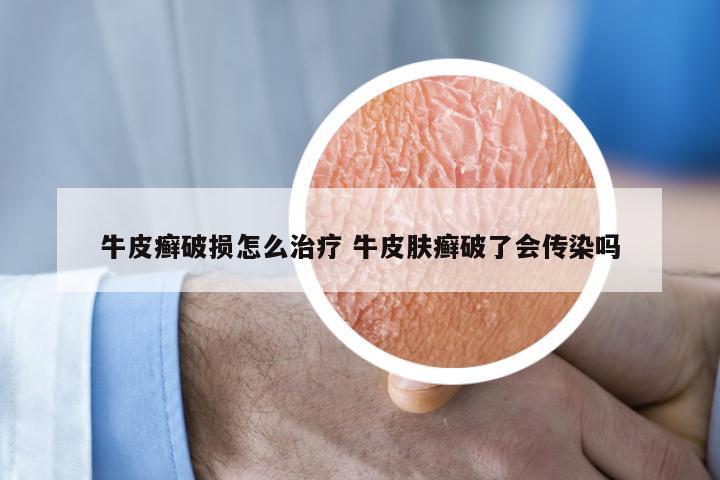 牛皮癣破损怎么治疗 牛皮肤癣破了会传染吗