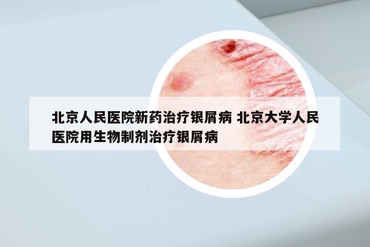 北京人民医院新药治疗银屑病 北京大学人民医院用生物制剂治疗银屑病