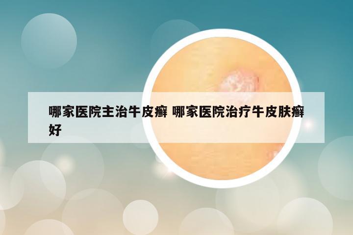 哪家医院主治牛皮癣 哪家医院治疗牛皮肤癣好