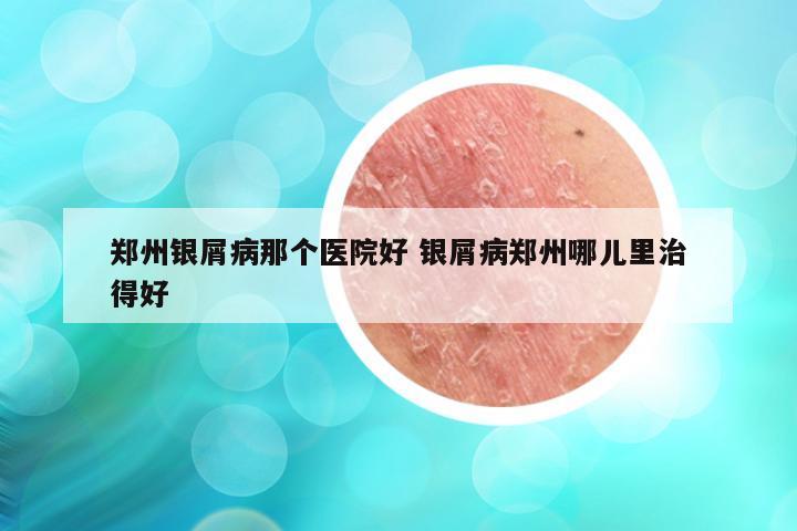 郑州银屑病那个医院好 银屑病郑州哪儿里治得好