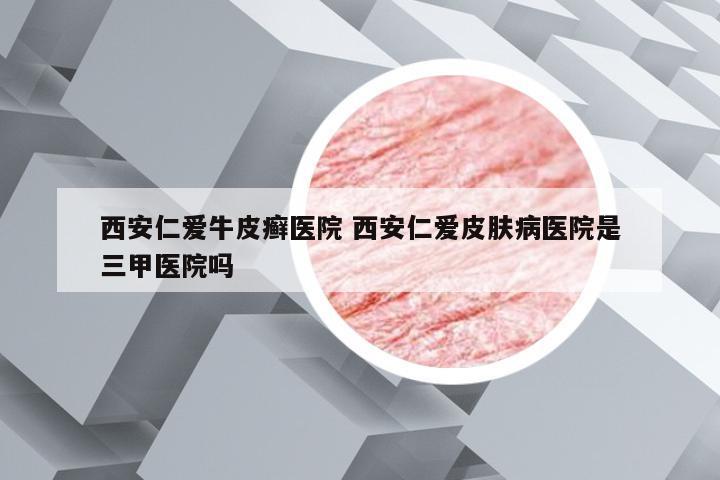 西安仁爱牛皮癣医院 西安仁爱皮肤病医院是三甲医院吗