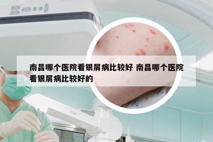 南昌哪个医院看银屑病比较好 南昌哪个医院看银屑病比较好的