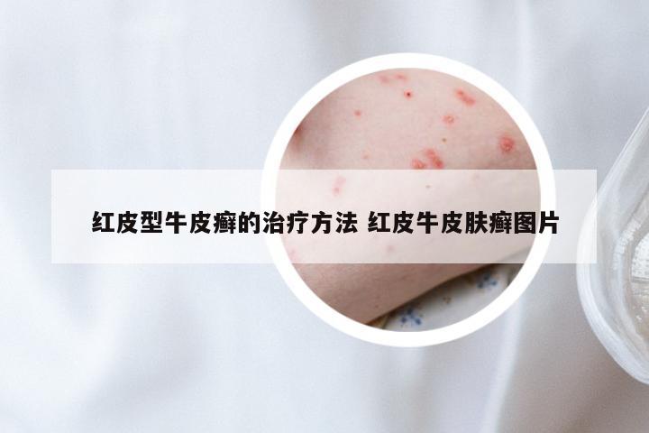 红皮型牛皮癣的治疗方法 红皮牛皮肤癣图片