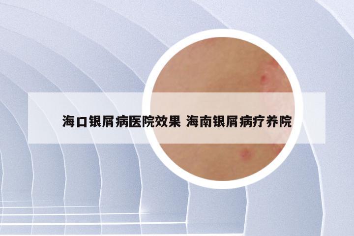 海口银屑病医院效果 海南银屑病疗养院