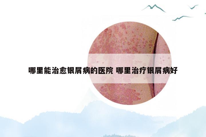 哪里能治愈银屑病的医院 哪里治疗银屑病好