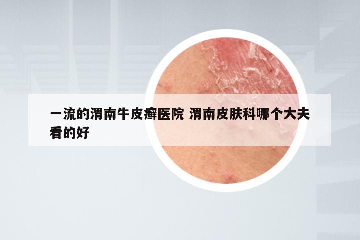 一流的渭南牛皮癣医院 渭南皮肤科哪个大夫看的好