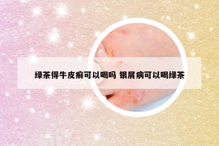 绿茶得牛皮癣可以喝吗 银屑病可以喝绿茶