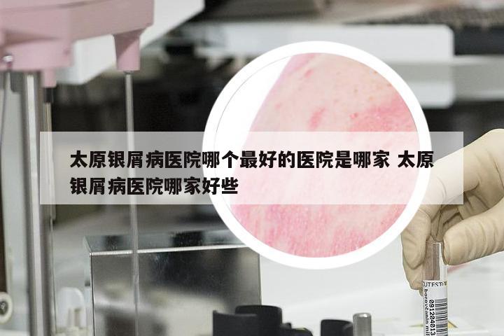太原银屑病医院哪个最好的医院是哪家 太原银屑病医院哪家好些