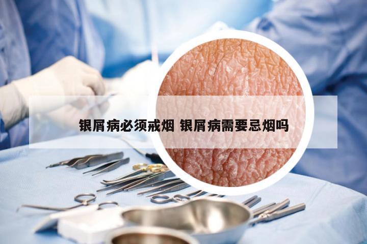 银屑病必须戒烟 银屑病需要忌烟吗