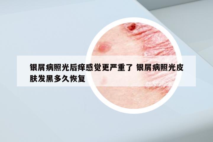 银屑病照光后痒感觉更严重了 银屑病照光皮肤发黑多久恢复