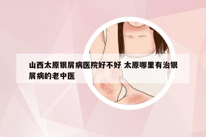 山西太原银屑病医院好不好 太原哪里有治银屑病的老中医