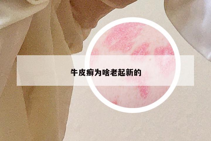 牛皮癣为啥老起新的