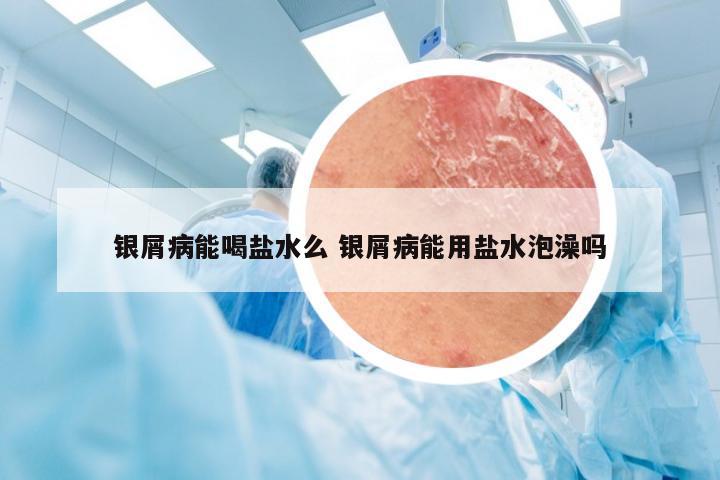 银屑病能喝盐水么 银屑病能用盐水泡澡吗