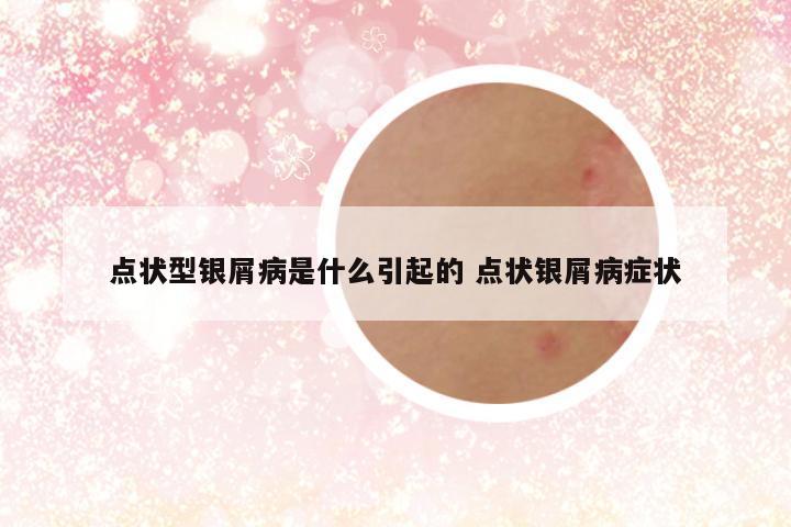点状型银屑病是什么引起的 点状银屑病症状