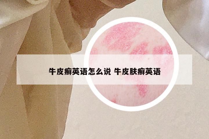 牛皮癣英语怎么说 牛皮肤癣英语
