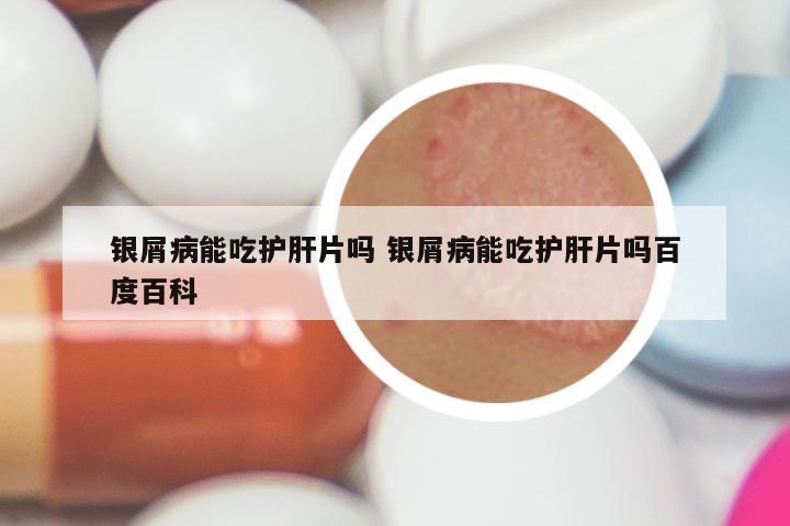 银屑病能吃护肝片吗 银屑病能吃护肝片吗百度百科