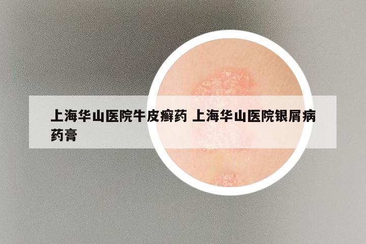 上海华山医院牛皮癣药 上海华山医院银屑病药膏