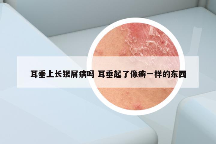 耳垂上长银屑病吗 耳垂起了像癣一样的东西