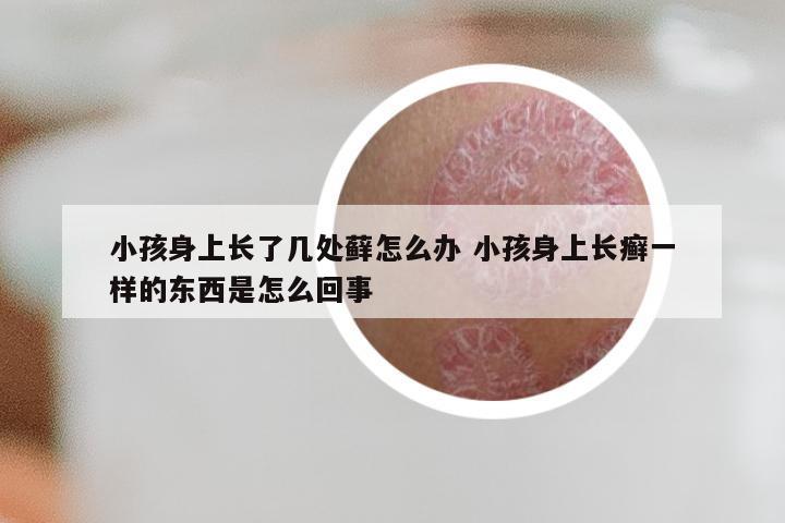 小孩身上长了几处藓怎么办 小孩身上长癣一样的东西是怎么回事