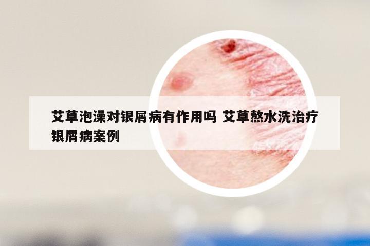 艾草泡澡对银屑病有作用吗 艾草熬水洗治疗银屑病案例