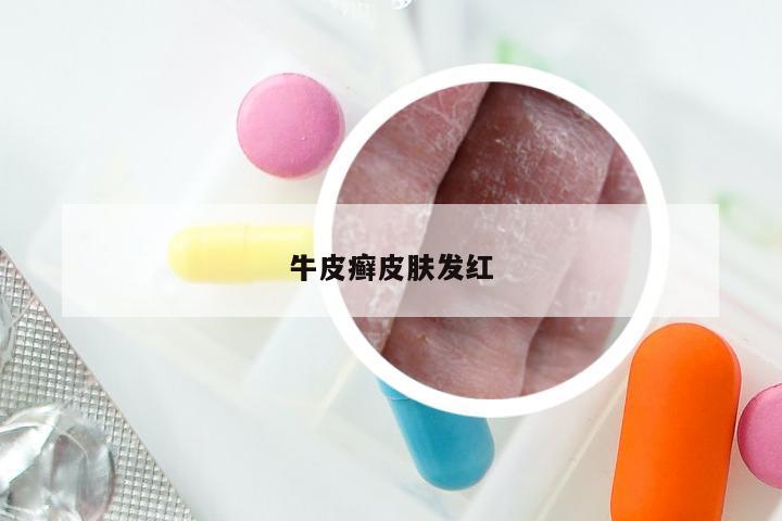 牛皮癣皮肤发红