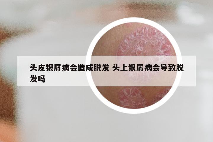 头皮银屑病会造成脱发 头上银屑病会导致脱发吗