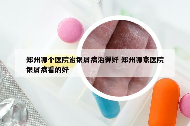 郑州哪个医院治银屑病治得好 郑州哪家医院银屑病看的好