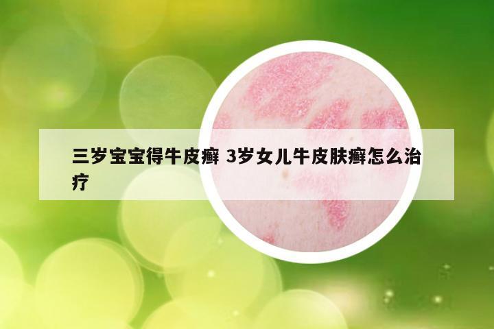 三岁宝宝得牛皮癣 3岁女儿牛皮肤癣怎么治疗