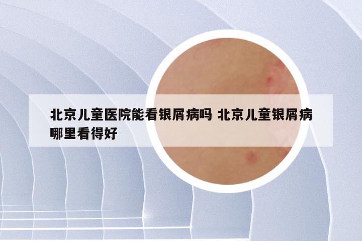 北京儿童医院能看银屑病吗 北京儿童银屑病哪里看得好