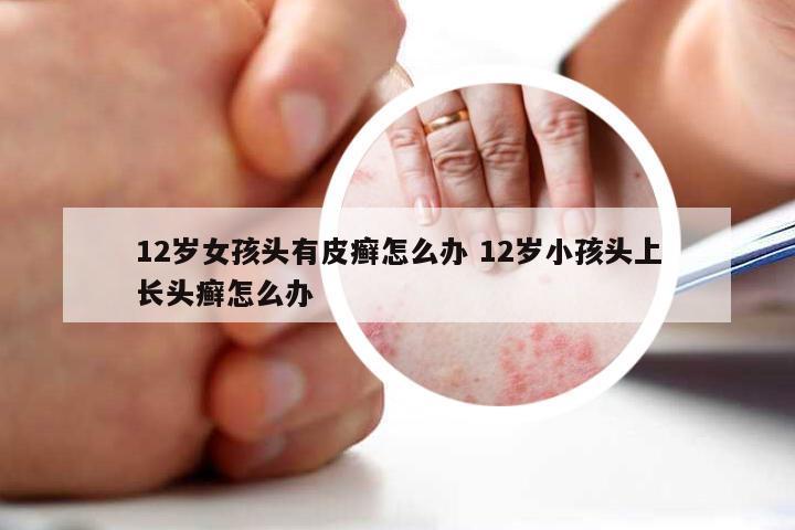 12岁女孩头有皮癣怎么办 12岁小孩头上长头癣怎么办