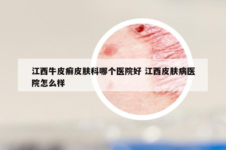 江西牛皮癣皮肤科哪个医院好 江西皮肤病医院怎么样