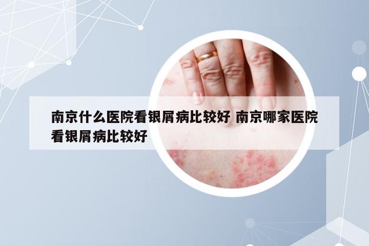 南京什么医院看银屑病比较好 南京哪家医院看银屑病比较好