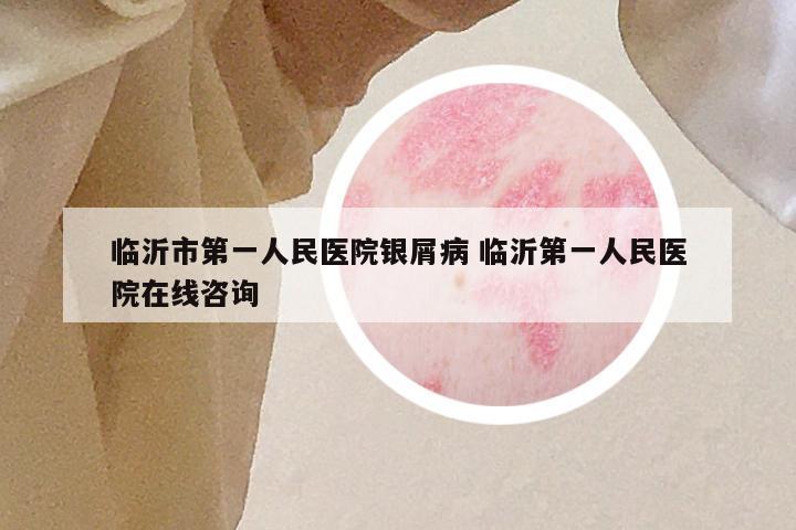 临沂市第一人民医院银屑病 临沂第一人民医院在线咨询