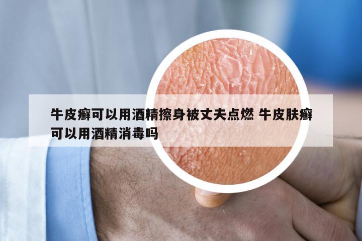 牛皮癣可以用酒精擦身被丈夫点燃 牛皮肤癣可以用酒精消毒吗