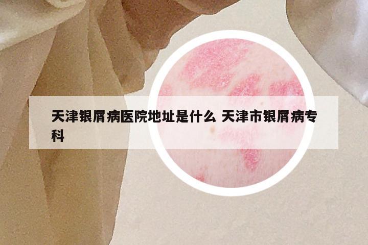 天津银屑病医院地址是什么 天津市银屑病专科