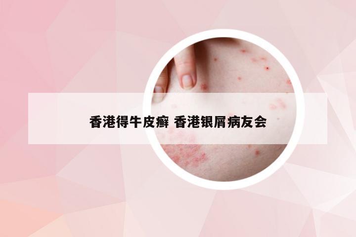 香港得牛皮癣 香港银屑病友会
