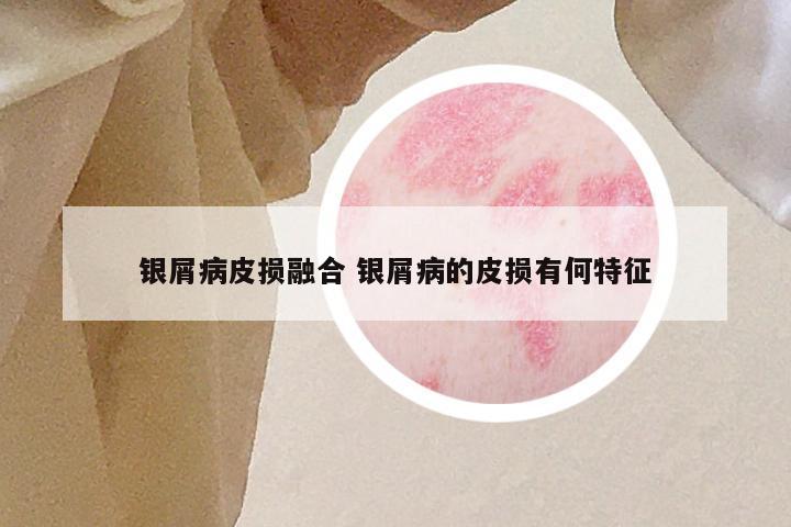 银屑病皮损融合 银屑病的皮损有何特征